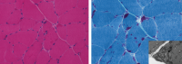 Nemaline - Pathology and Cell Biology, Columbia University